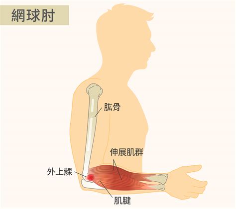 骨節手|手肘痛、手腕痛、手指痛的原因,治療與自我檢查 » 台。